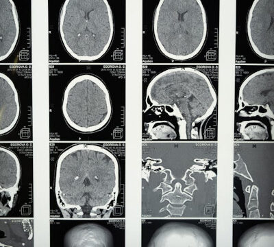 mri of the brain